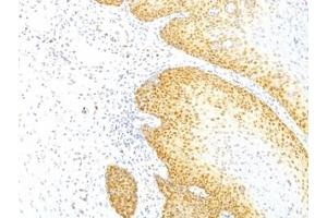 Formalin-fixed, paraffin-embedded human cervical cancer stained with p27Kip1 antibody (KIP1/769) (CDKN1B antibody)