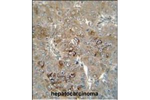 CES4 antibody (N-term) (ABIN654667 and ABIN2844363) immunohistochemistry analysis in formalin fixed and paraffin embedded human hepatocarcinoma followed by peroxidase conjugation of the secondary antibody and DAB staining. (CES1P1 antibody  (N-Term))