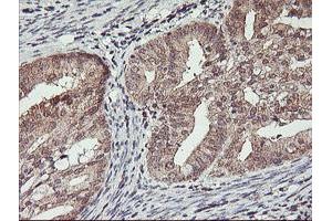 Immunohistochemical staining of paraffin-embedded Adenocarcinoma of Human endometrium tissue using anti-HLCS mouse monoclonal antibody. (HLCS antibody)