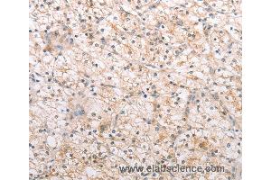 Immunohistochemistry of Human renal cancer using MMP11 Polyclonal Antibody at dilution of 1:40
