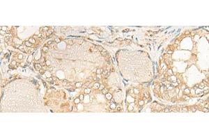 Immunohistochemistry of paraffin-embedded Human thyroid cancer tissue using DUSP27 Polyclonal Antibody at dilution of 1:50(x200)