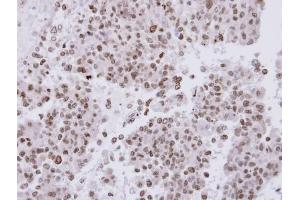 IHC-P Image Immunohistochemical analysis of paraffin-embedded OV90 xenograft, using FACA, antibody at 1:500 dilution. (FANCA antibody  (N-Term))