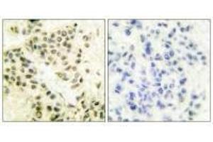 Immunohistochemical analysis of paraffin-embedded human breast carcinoma tissue using DNA-PK antibody.