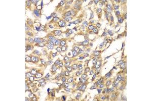 Immunohistochemistry of paraffin-embedded human esophageal cancer using VTI1B antibody at dilution of 1:100 (x40 lens).