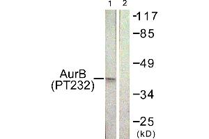 Immunohistochemistry analysis of paraffin-embedded human liver carcinoma tissue using AurB (Phospho-Thr232) antibody. (Aurora Kinase B antibody  (pThr232))