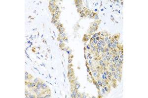 Immunohistochemistry of paraffin-embedded human lung cancer using DARS2 antibody at dilution of 1:100 (x40 lens). (DARS2 antibody)