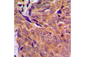 Immunohistochemical analysis of CHK1 staining in human breast cancer formalin fixed paraffin embedded tissue section. (CHEK1 antibody  (Center))