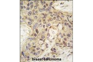 Formalin-fixed and paraffin-embedded human breast carcinoma tissue reacted with ANGEL2 antibody (Center) (ABIN389224 and ABIN2839377) , which was peroxidase-conjugated to the secondary antibody, followed by DAB staining. (ANGEL2 antibody  (AA 108-138))