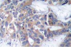 Immunohistochemistry (IHC) analyzes of p-MEK-1/2 antibody in paraffin-embedded human breast carcinoma tissue. (MEK1 antibody  (pSer218, pSer222))