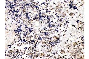TRF2 was detected in paraffin-embedded sections of human lung cancer tissues using rabbit anti- TRF2 Antigen Affinity purified polyclonal antibody (Catalog # ) at 1 µg/mL.