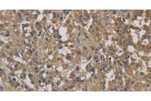 Immunohistochemistry of paraffin-embedded Human thyroid cancer tissue using DCTN3 Polyclonal Antibody at dilution 1:70 (DCTN3 antibody)