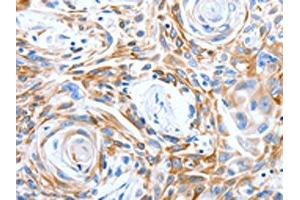 The image on the left is immunohistochemistry of paraffin-embedded Human esophagus cancer tissue using ABIN7191315(LRIG3 Antibody) at dilution 1/50, on the right is treated with synthetic peptide. (LRIG3 antibody)