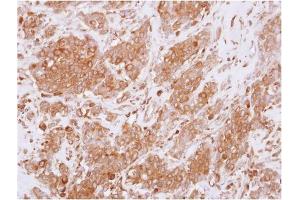 AP31125PU-N RGS10 antibody staining of Paraffin-Embedded Breast Carcinoma at 1/250 dilution. (RGS10 antibody  (AA 1-160))