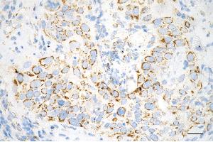 Immunohistochemistry was performed on paraffin-embedded human esophageal carcinoma using caspase 8 antibody (ABIN7797905), 1:100). (Caspase 8 antibody)