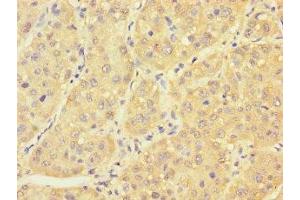 Immunohistochemistry of paraffin-embedded human liver cancer using ABIN7166614 at dilution of 1:100 (PCBD1 antibody  (AA 2-104))