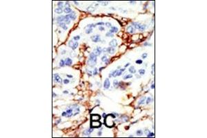 Formalin-fixed and paraffin-embedded human cancer tissue reacted with the primary antibody, which was peroxidase-conjugated to the secondary antibody, followed by DAB staining. (DOK2 antibody  (C-Term))