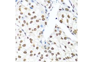Immunohistochemistry of paraffin-embedded human prostate cancer using Ku80 antibody (ABIN6130932, ABIN6150308, ABIN6150310 and ABIN6217336) at dilution of 1:100 (40x lens). (XRCC5 antibody  (AA 540-732))