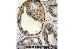 AKT1 antibody (Thr308) immunohistochemistry analysis in formalin fixed and paraffin embedded human breast carcinoma followed by peroxidase conjugation of the secondary antibody and DAB staining. (AKT1 antibody  (AA 289-318))