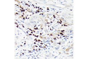 Immunohistochemistry of paraffin-embedded human liver cancer using MMP8 Rabbit pAb (ABIN3015770, ABIN3015771, ABIN3015772 and ABIN6219115) at dilution of 1:150 (40x lens).