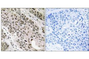 Immunohistochemistry analysis of paraffin-embedded human lung carcinoma tissue using TNNI3K antibody. (TNNI3K antibody  (Internal Region))