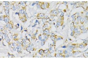 Immunohistochemistry of paraffin-embedded Human breast cancer using ATP5J Polyclonal Antibody at dilution of 1:100 (40x lens). (ATP5J antibody)