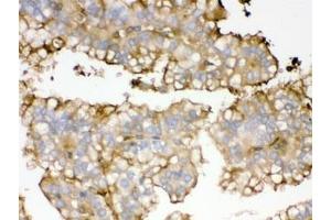 IHC testing of FFPE human kidney cancer tissue with APOA1 antibody. (APOA1 antibody)
