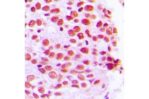 Immunohistochemical analysis of PE2 staining in human breast cancer formalin fixed paraffin embedded tissue section. (ERF antibody  (C-Term))