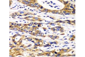 Immunohistochemistry of paraffin-embedded Human gastric cancer using RPN1 Polyclonal Antibody at dilution of 1:100 (40x lens). (RPN1 antibody)