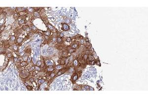 ABIN6277791 at 1/100 staining Human Head and neck cancer tissue by IHC-P. (CD11c antibody  (N-Term))