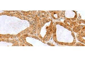 Immunohistochemistry of paraffin-embedded Human thyroid cancer tissue using RPS16 Polyclonal Antibody at dilution of 1:60(x200) (RPS16 antibody)