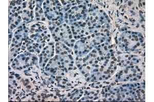 Immunohistochemical staining of paraffin-embedded Carcinoma of kidney tissue using antiHSPA9mouse monoclonal antibody. (HSPA9 antibody)