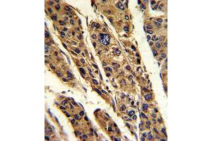 Formalin-fixed and paraffin-embedded human hepatocarcinoma reacted with TPT1 Antibody (Center), which was peroxidase-conjugated to the secondary antibody, followed by DAB staining. (TPT1 antibody  (AA 85-113))