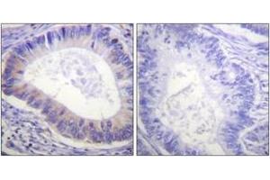 Immunohistochemistry analysis of paraffin-embedded human colon carcinoma, using PDE4D (Phospho-Ser190/53) Antibody. (PDE4D antibody  (pSer190))