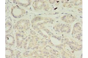 Immunohistochemistry of paraffin-embedded human breast cancer using ABIN7175188 at dilution of 1:100 (VSIG2 antibody  (AA 24-243))