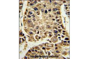 Formalin-fixed and paraffin-embedded human hepatocarcinoma reacted with SERPINA4 Antibody , which was peroxidase-conjugated to the secondary antibody, followed by DAB staining. (SERPINA4 antibody  (C-Term))