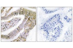 Immunohistochemistry analysis of paraffin-embedded human lung carcinoma tissue using TACC3 antibody.