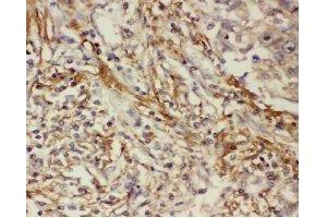 Immunohistochemistry analysis of paraffin-embedded human lung cancer tissue using COX2 Antibody (1/200 dilution). (COX2 antibody)