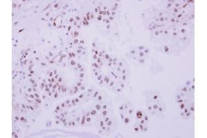IHC-P Image Immunohistochemical analysis of paraffin-embedded human ovarian cancer, using Topoisomerase II beta, antibody at 1:250 dilution.
