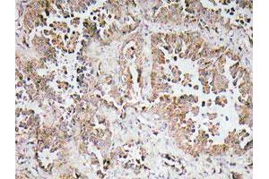 Immunohistochemical analysis of paraffin-embedded human lung cancer tissue using OR6P1 polyclonal antibody .