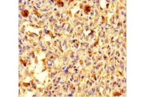 Immunohistochemistry of paraffin-embedded human melanoma using ABIN7146155 at dilution of 1:100 (C2 Calcium-Dependent Domain-Containing Protein 6 (C2CD6) (AA 401-623) antibody)