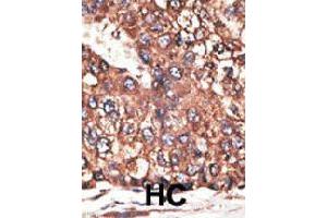 Formalin-fixed and paraffin-embedded human hepatocellular carcinoma tissue reacted with LEPR polyclonal antibody  , which was peroxidase-conjugated to the secondary antibody, followed by DAB staining. (Leptin Receptor antibody  (N-Term))