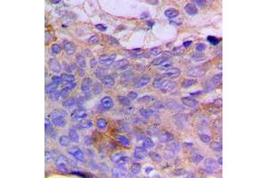 Immunohistochemical analysis of CSGALNACT1 staining in human breast cancer formalin fixed paraffin embedded tissue section. (CSGALNACT1 antibody  (Center))