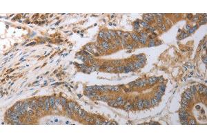 Immunohistochemistry of paraffin-embedded Human colon cancer using SLC22A6 Polyclonal Antibody at dilution of 1:40 (SLC22A6 antibody)