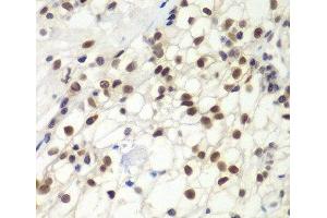 Immunohistochemistry of paraffin-embedded Human kidney cancer using MSH6 Polyclonal Antibody at dilution of 1:100 (40x lens). (MSH6 antibody)