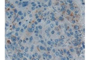 Detection of SMAD5 in Human Liver cancer Tissue using Polyclonal Antibody to SMAD family member 5 (SMAD5) (SMAD5 antibody  (AA 210-464))