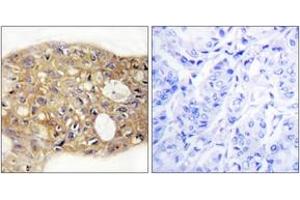 Immunohistochemistry analysis of paraffin-embedded human breast carcinoma tissue, using AGR3 Antibody.