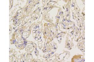 Immunohistochemistry of paraffin-embedded human lung using ARRB1 antibody (ABIN5996907) at dilution of 1/100 (40x lens). (beta Arrestin 1 antibody)