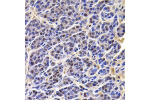 Immunohistochemistry of paraffin-embedded human liver cancer using HIRIP3 antibody (ABIN5974221) at dilution of 1/100 (40x lens). (HIRIP3 antibody)
