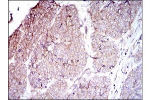 Immunohistochemical analysis of paraffin-embedded esophageal cancer tissues using ITGB4 mouse mAb with DAB staining. (Integrin beta 4 antibody  (AA 1619-1822))