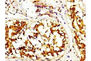 IHC image of ABIN7146664 diluted at 1:200 and staining in paraffin-embedded human breast cancer performed on a Leica BondTM system. (Caprin-1 antibody  (AA 573-703))